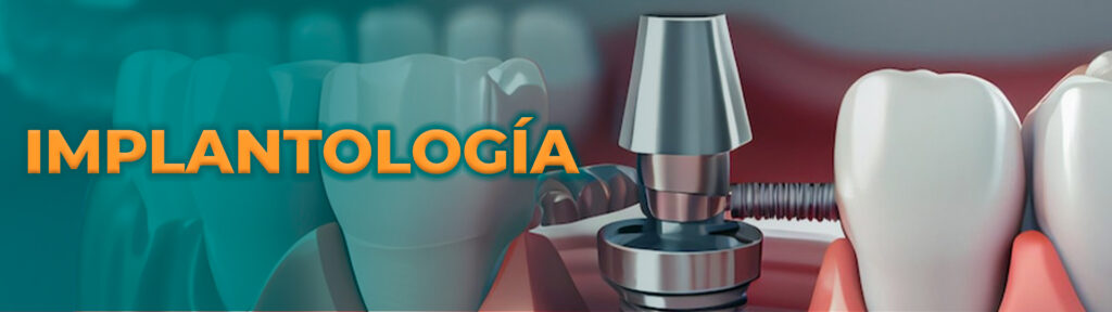IMPLANTOLOGÍA implantes dentales odontobig